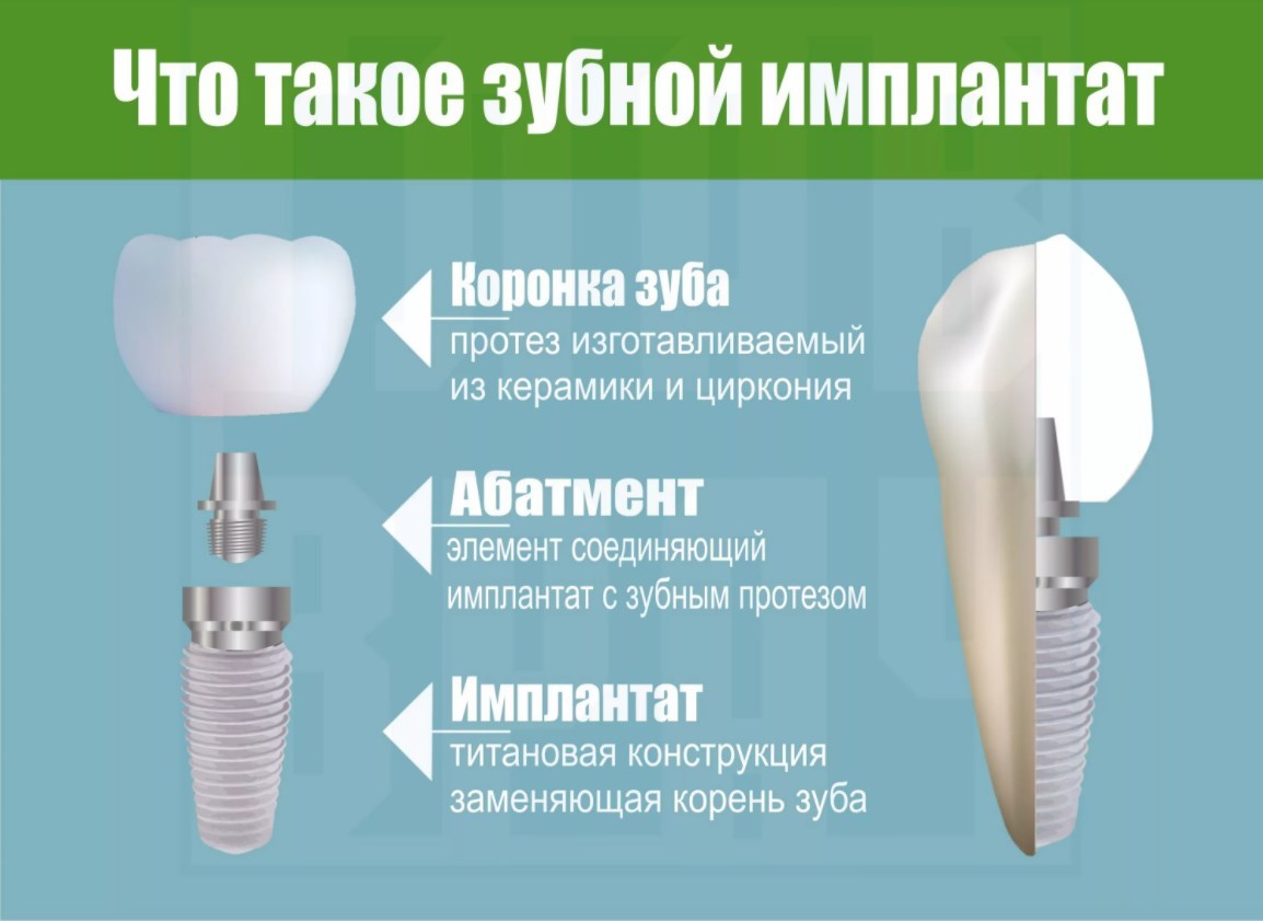 № 17. Имплант или мост - что лучше? - Моё, Стоматология, Длиннопост, Имплантация зубов