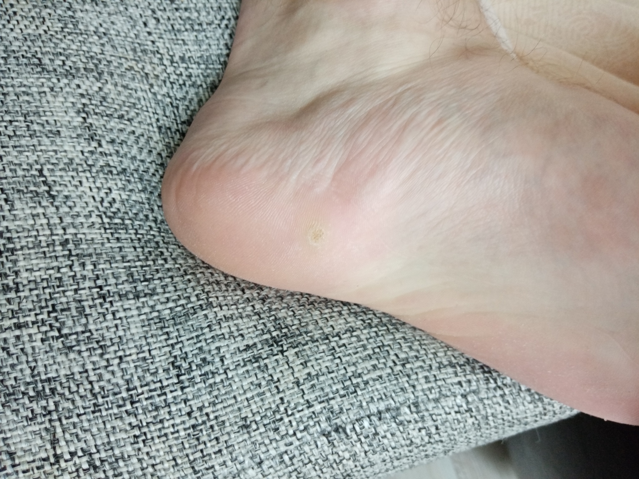 Incomprehensible formations on the feet - My, Feet, Disease, Fungus, Dermatology, Longpost