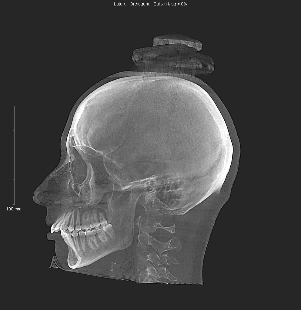 Surgery to expand the upper jaw, day 3 - My, Operation, Hospital, Maxillofacial Surgery, Bite correction, Malocclusion, Bite, Longpost, 