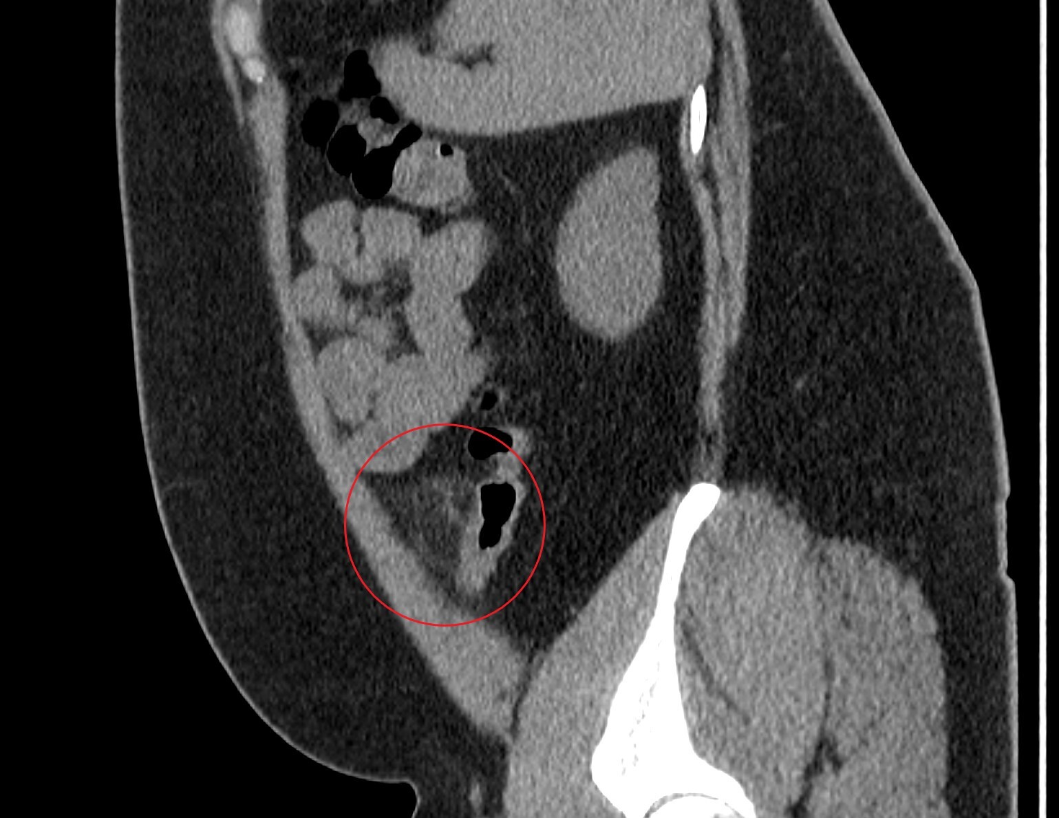 The appendix is different. Case Studies - My, Personal experience, Radiology, CT, Ultrasound, Appendix, Mat, Longpost, 