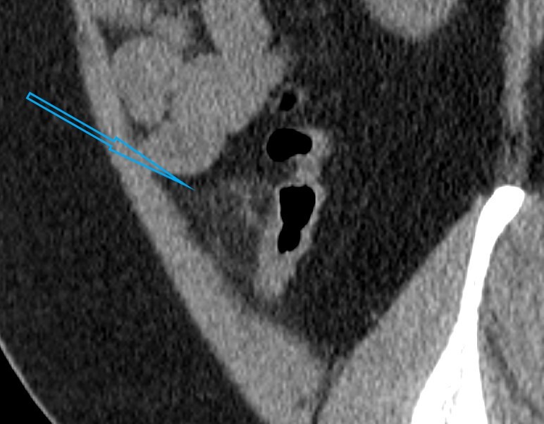 The appendix is different. Case Studies - My, Personal experience, Radiology, CT, Ultrasound, Appendix, Mat, Longpost, 