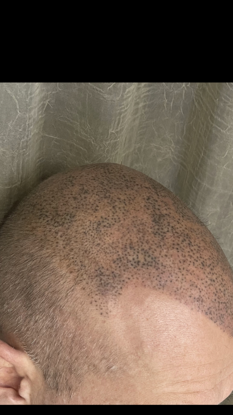 Masking a bald head by a crooked master - My, Bald head, Trichopigmentation, Longpost, 