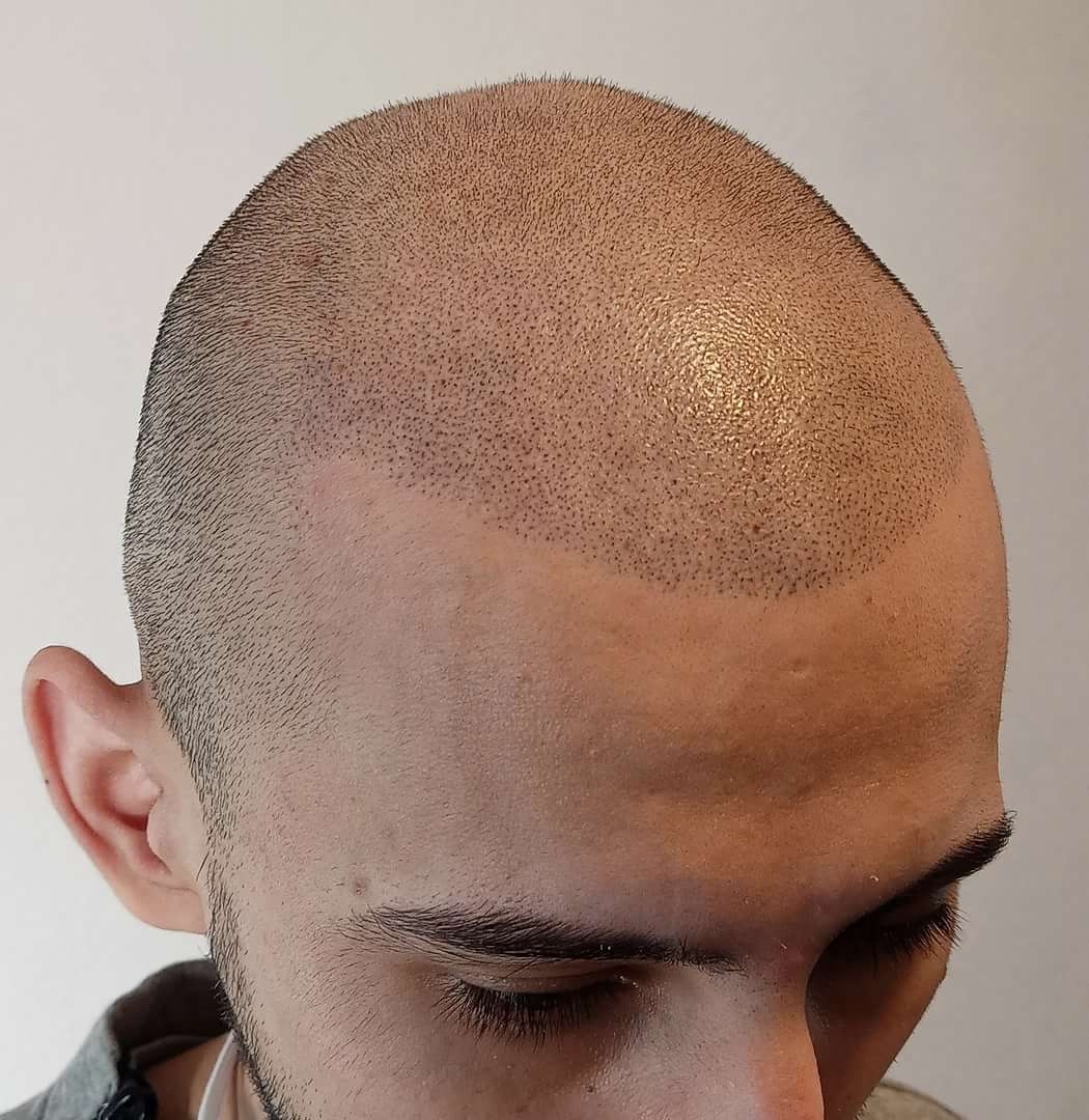 Masking a bald head by a crooked master - My, Bald head, Trichopigmentation, Longpost, 