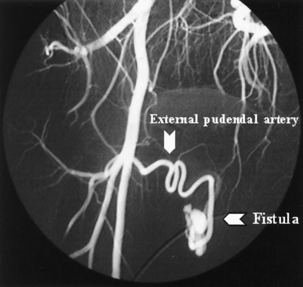 Varicocele, complications after surgery - My, Varicocele, Hernia, Circumcision, Complication, The medicine, Urology, Longpost