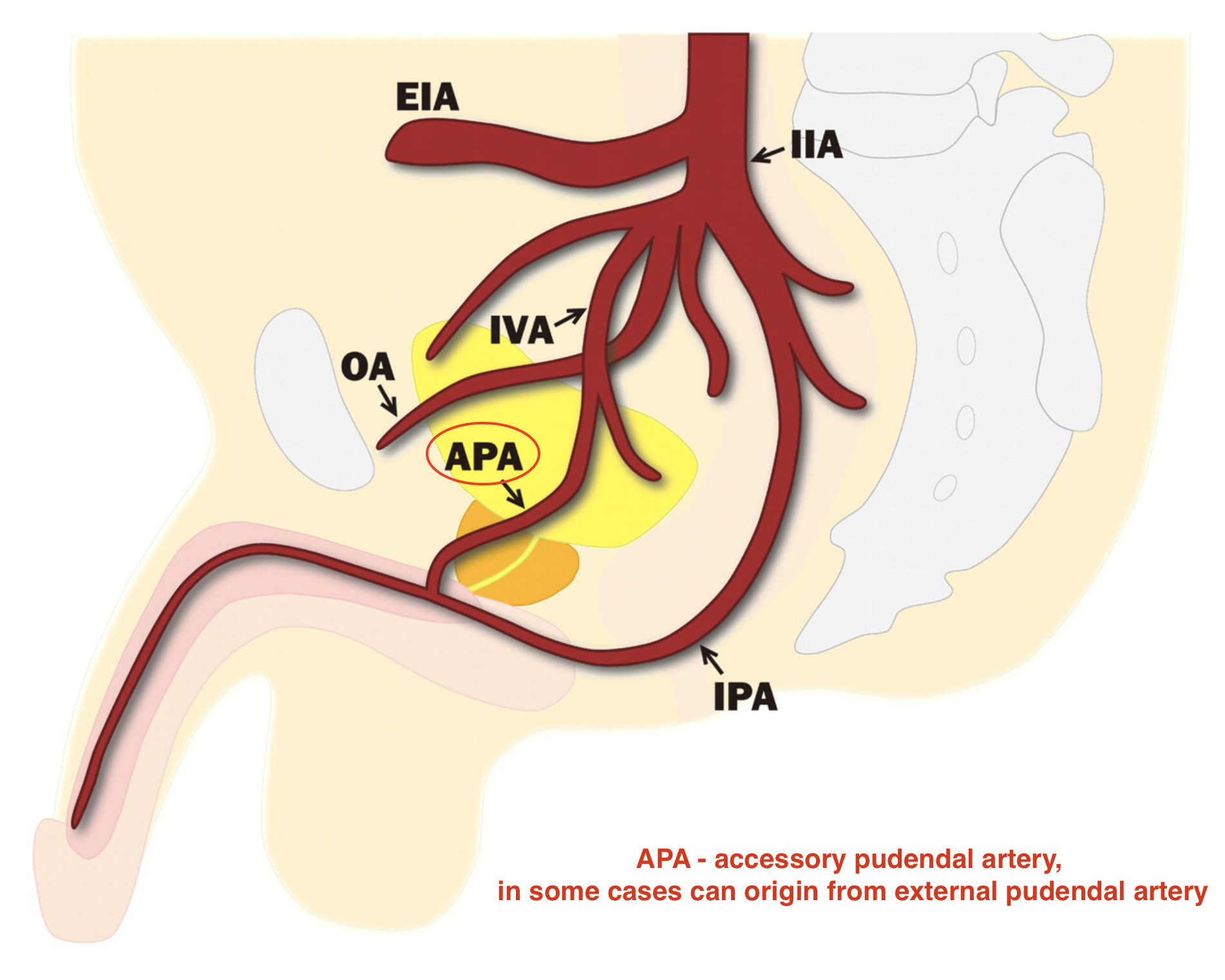 Varicocele, complications after surgery - My, Varicocele, Hernia, Circumcision, Complication, The medicine, Urology, Longpost