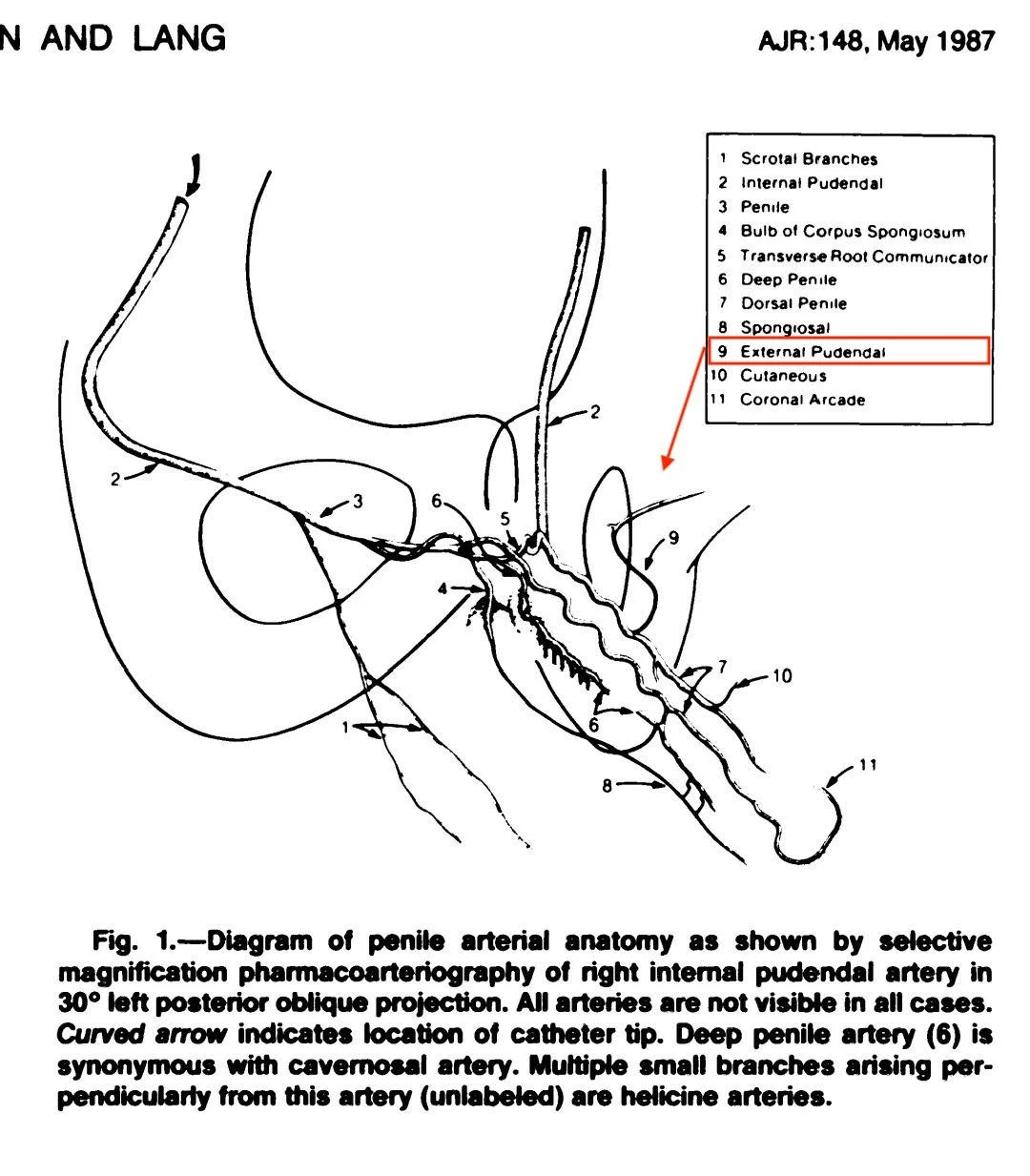 Varicocele, complications after surgery - My, Varicocele, Hernia, Circumcision, Complication, The medicine, Urology, Longpost