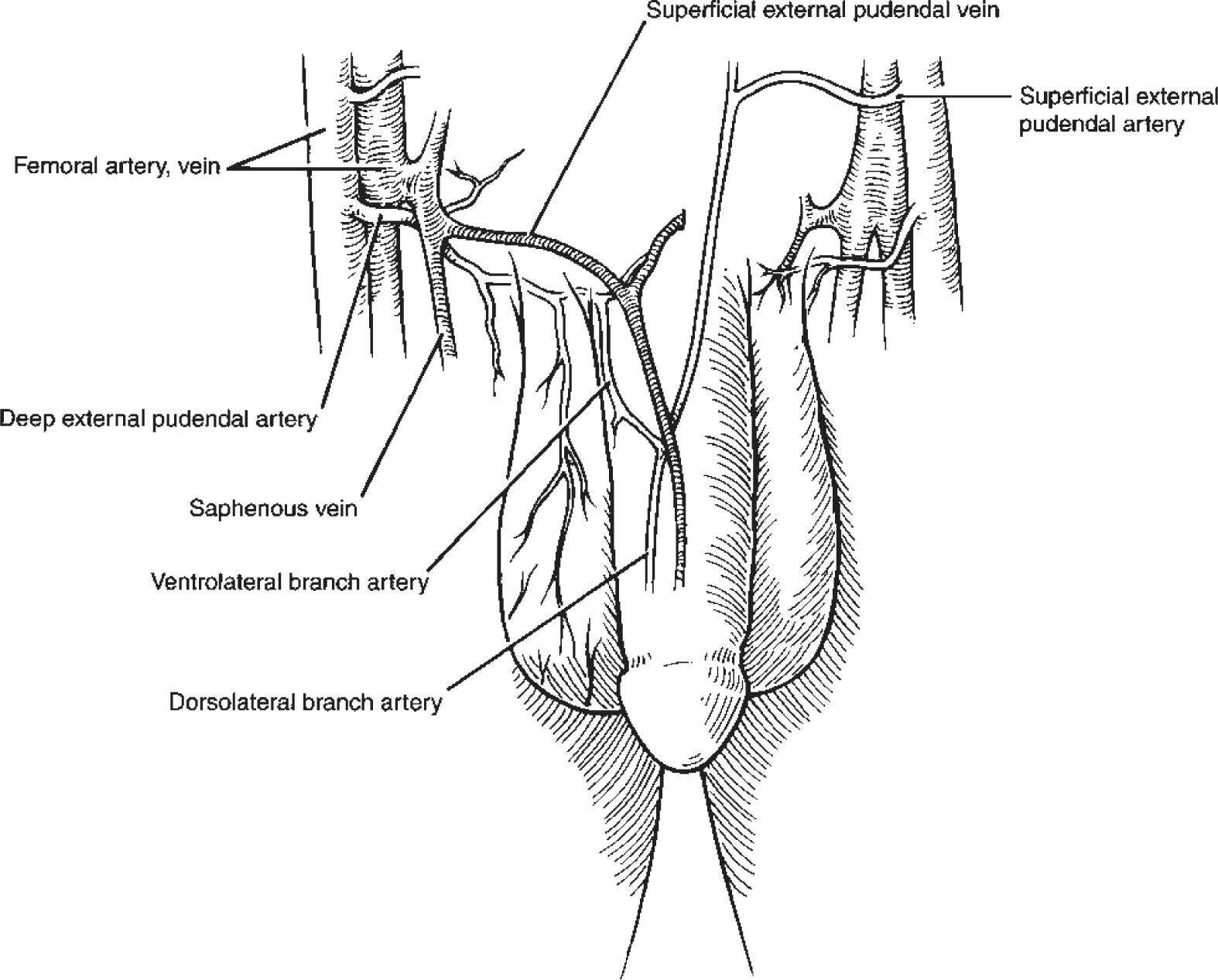 Varicocele, complications after surgery - My, Varicocele, Hernia, Circumcision, Complication, The medicine, Urology, Longpost