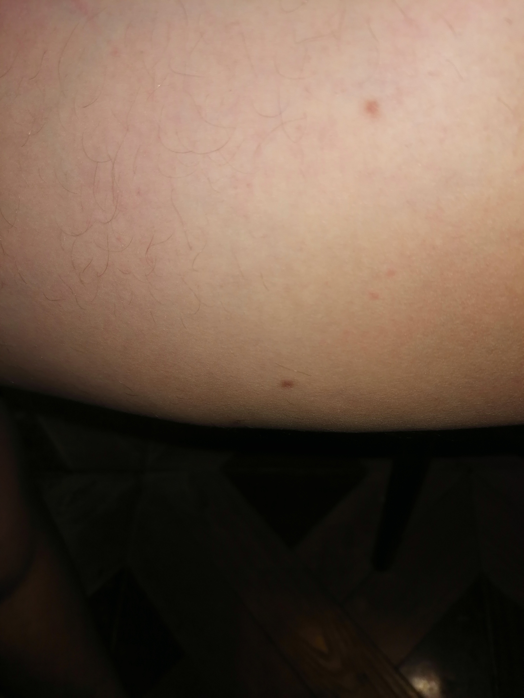 Need advice - My, Need advice, The medicine, Legs, Minuses, Varicose veins, Longpost, 