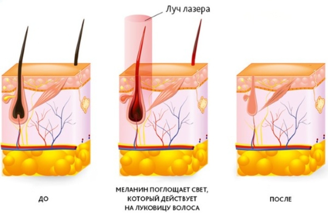 Про лазерную эпиляцию - Моё, Лазерное удаление, Лазерная эпиляция, Эпиляция, Мат, Длиннопост, 