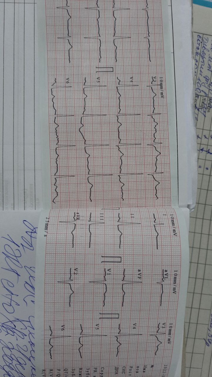 Decipher the cardiogram - Disease history, Disease, Treatment, Doctors, Cardiology, Longpost