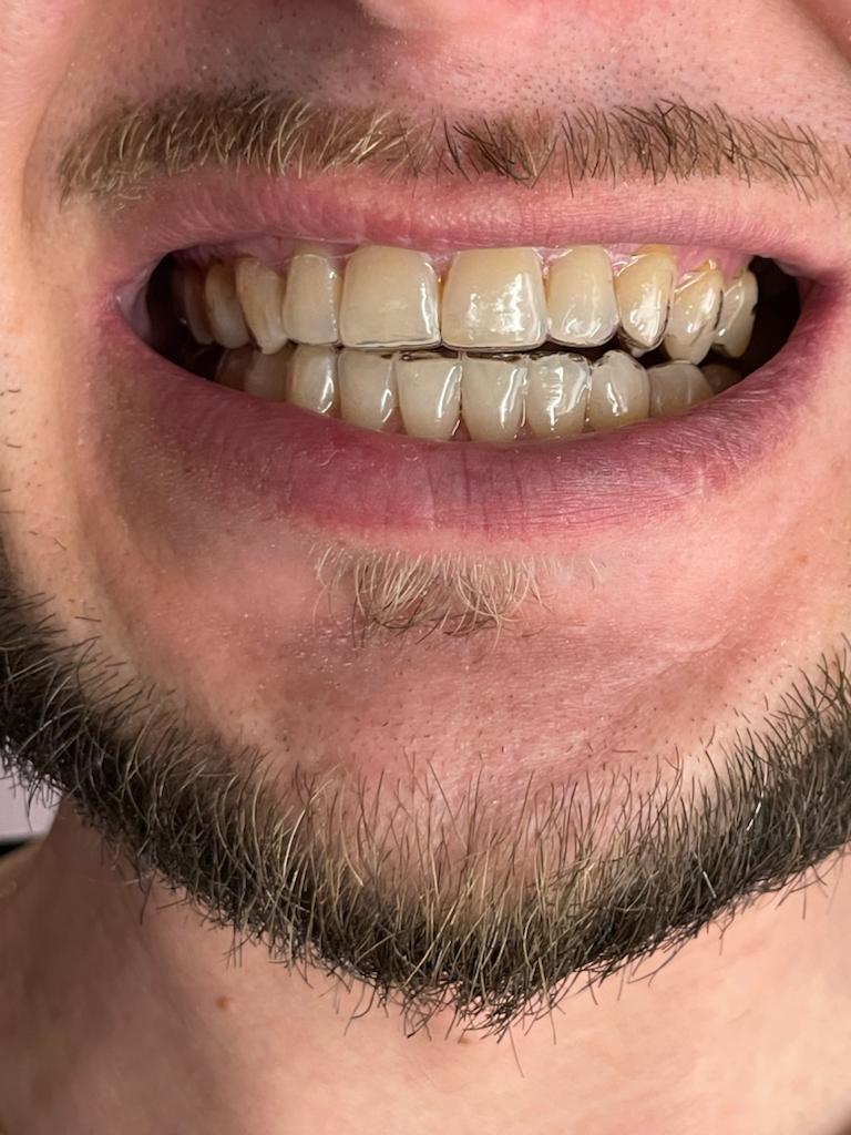 Aligners. Or how I overcame my children's complex - My, Dentistry, Aligners, Longpost