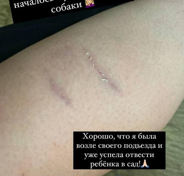 A resident of Shymanovsk said that she was bitten by a stray dog - Dog, Homeless animals, Stray dogs, Burmatov, Longpost