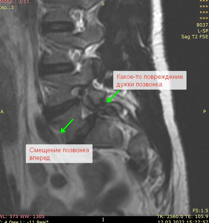Небольшой детектив о долгой боли в спине - Моё, Медицина, Здоровье, Лечение, Боль, Позвоночник, Неврология, Позитив, Длиннопост