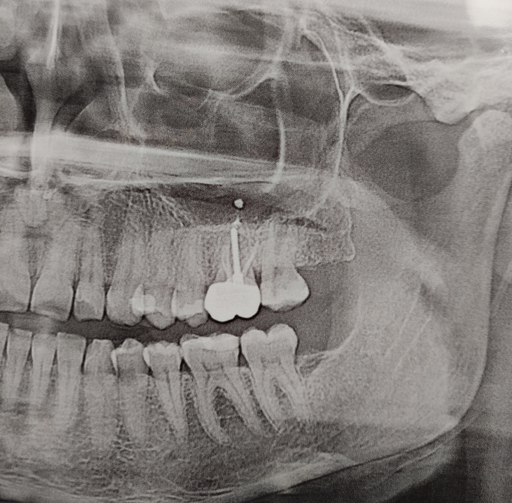 White dot in a panoramic picture of the teeth. What is this? - The medicine, Dentistry, Question, Problem