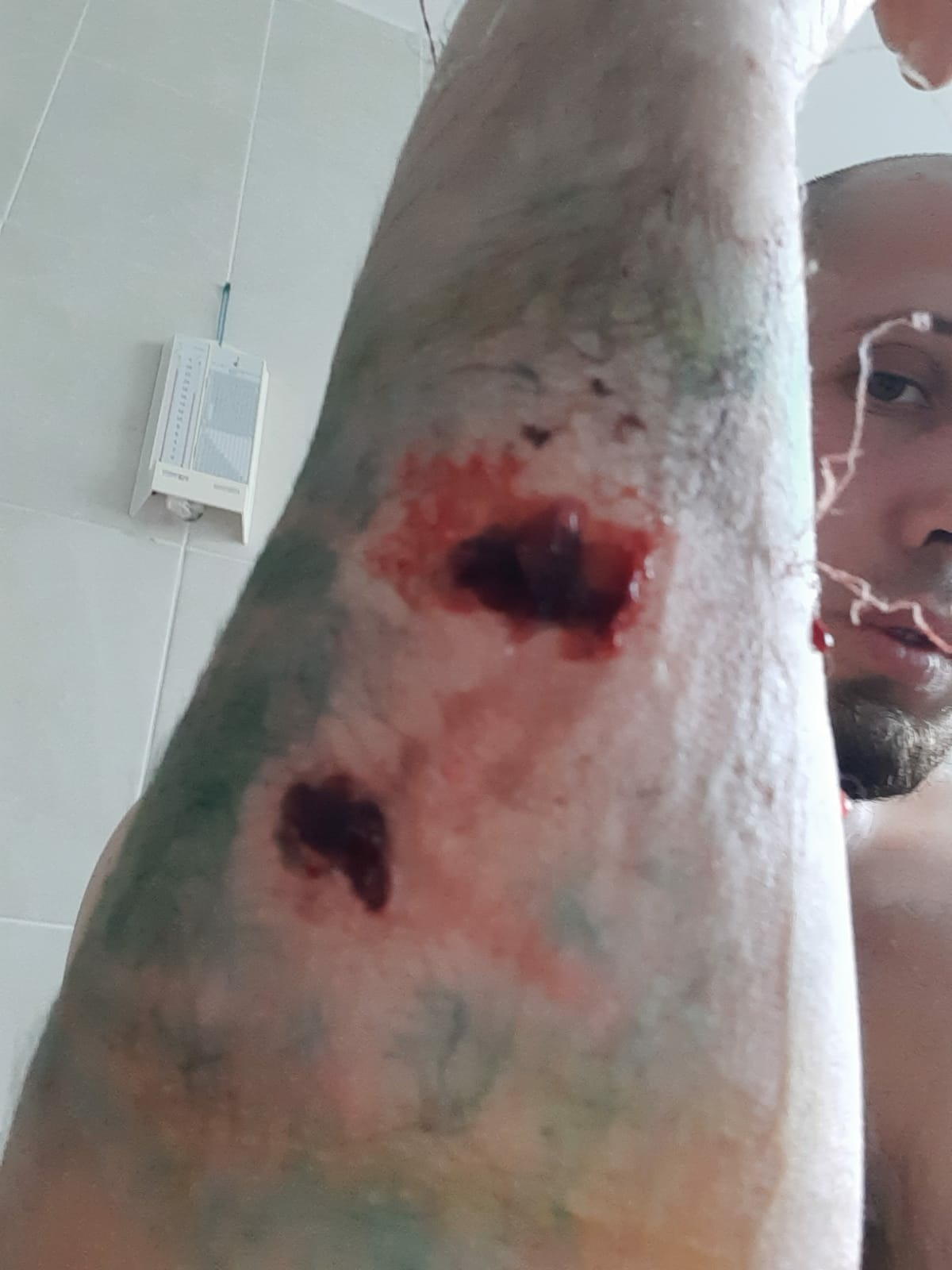 A man seriously injured by Alabai bites demands removal of the walking death from the streets - Negative, Dog, Alabai, Video, Youtube, Longpost, Dog attack