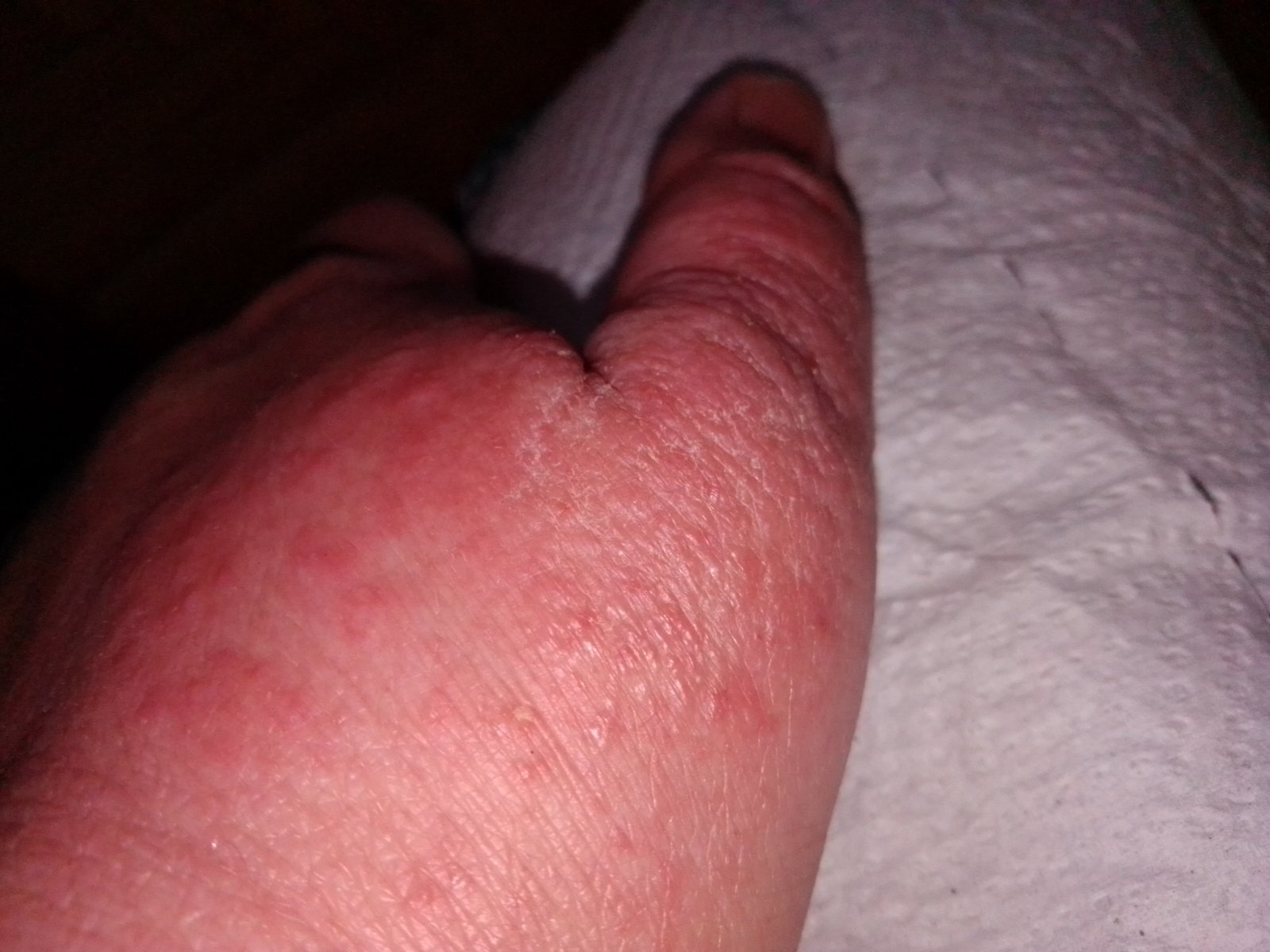 What is this rash and how to deal with it? - The medicine, Doctors, Rash, Leather, Treatment, Longpost, Doctors need help