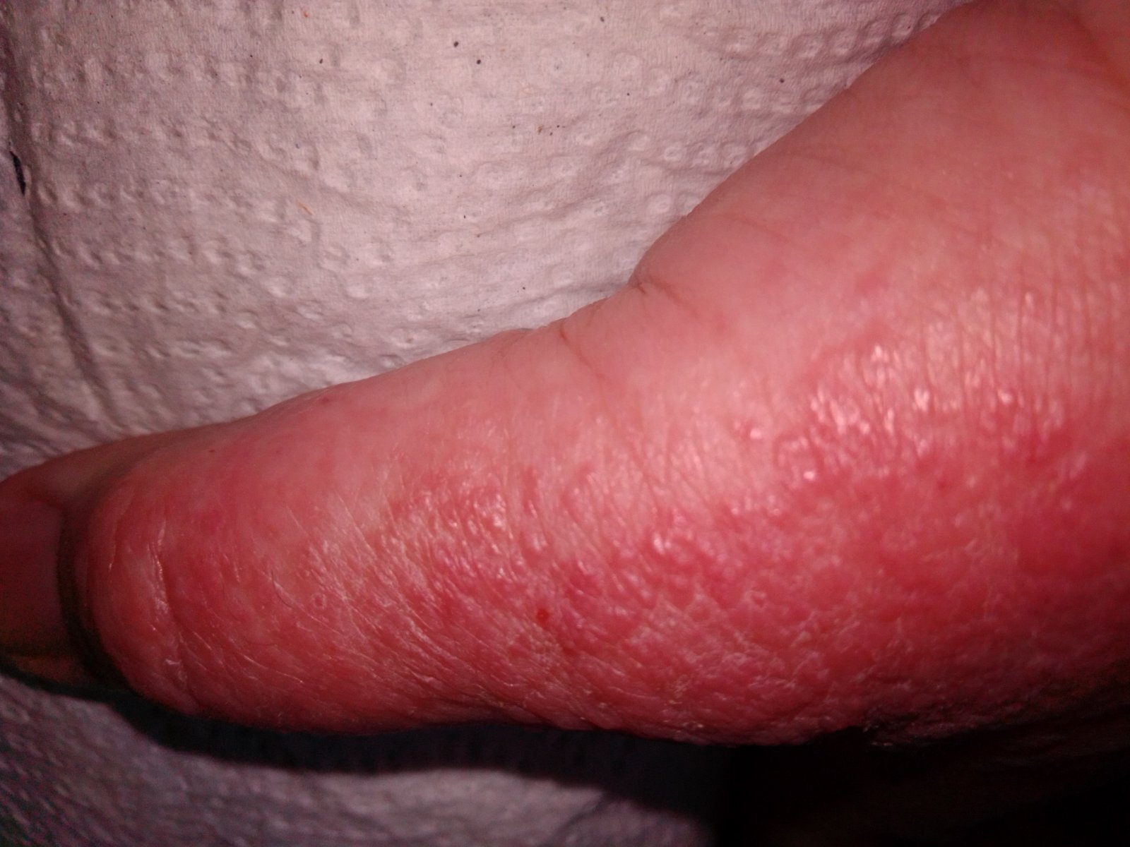 What is this rash and how to deal with it? - The medicine, Doctors, Rash, Leather, Treatment, Longpost, Doctors need help