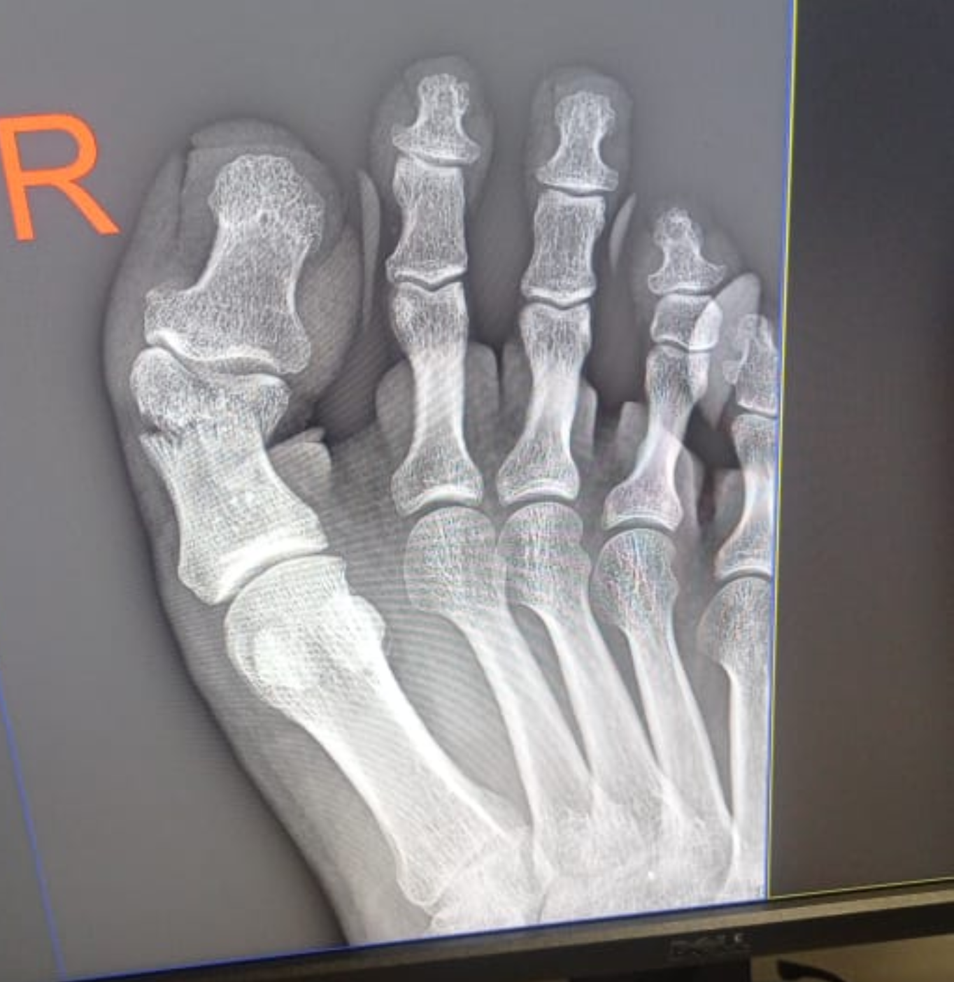 Displaced big toe fracture - My, Finger fracture, Traumatology, Recovery, Longpost