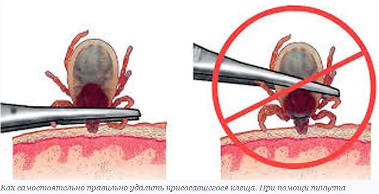 Что делать, если укусил клещ - Здоровье, Медицина, Клещ, Укус, Длиннопост