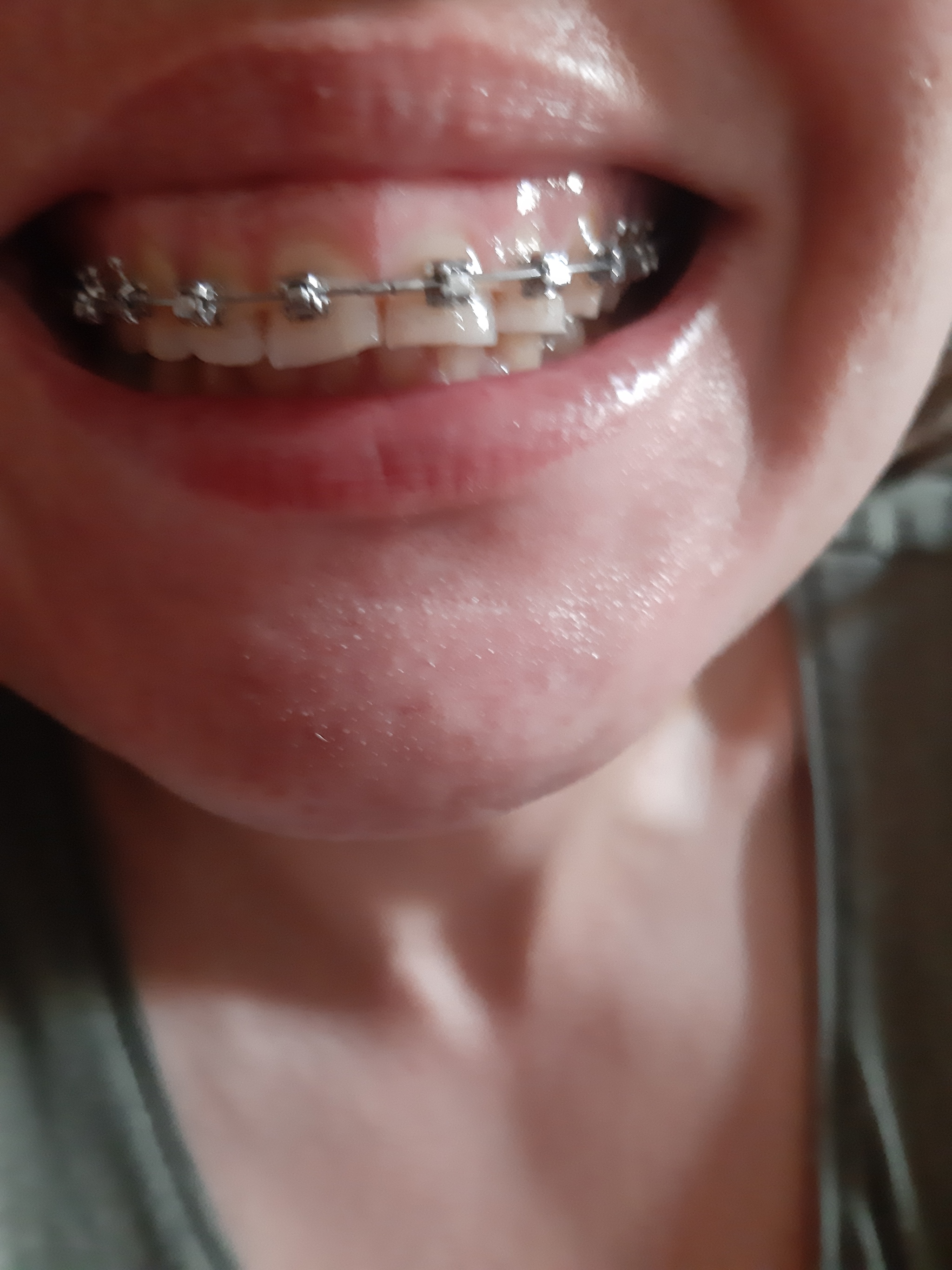 Braces at 35 - Braces, Teeth, Orthodontics, Smile, Age, Dentistry, beauty, Health, Expensive, Girls, Video, Vertical video, Longpost