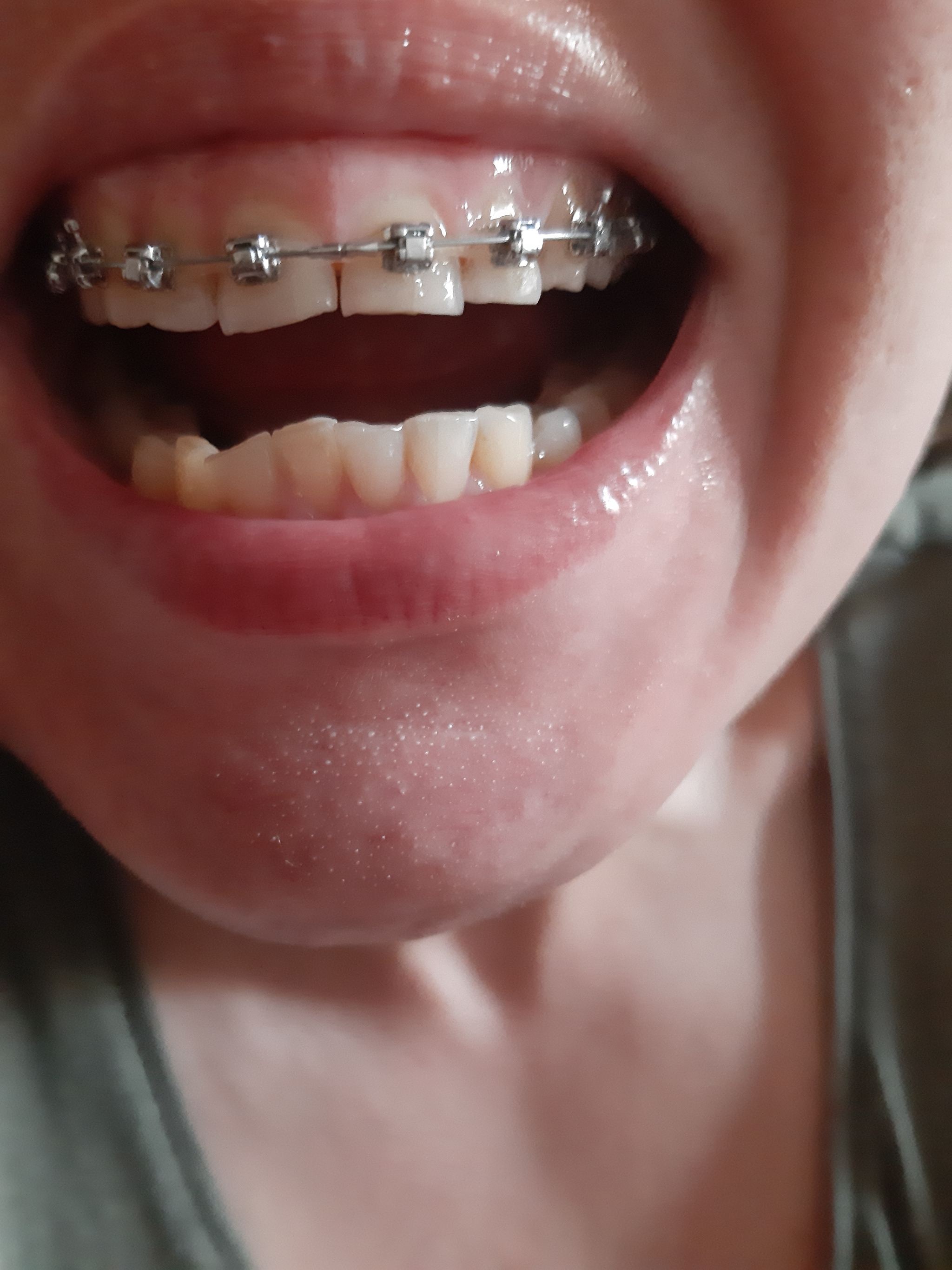 Braces at 35 - Braces, Teeth, Orthodontics, Smile, Age, Dentistry, beauty, Health, Expensive, Girls, Video, Vertical video, Longpost