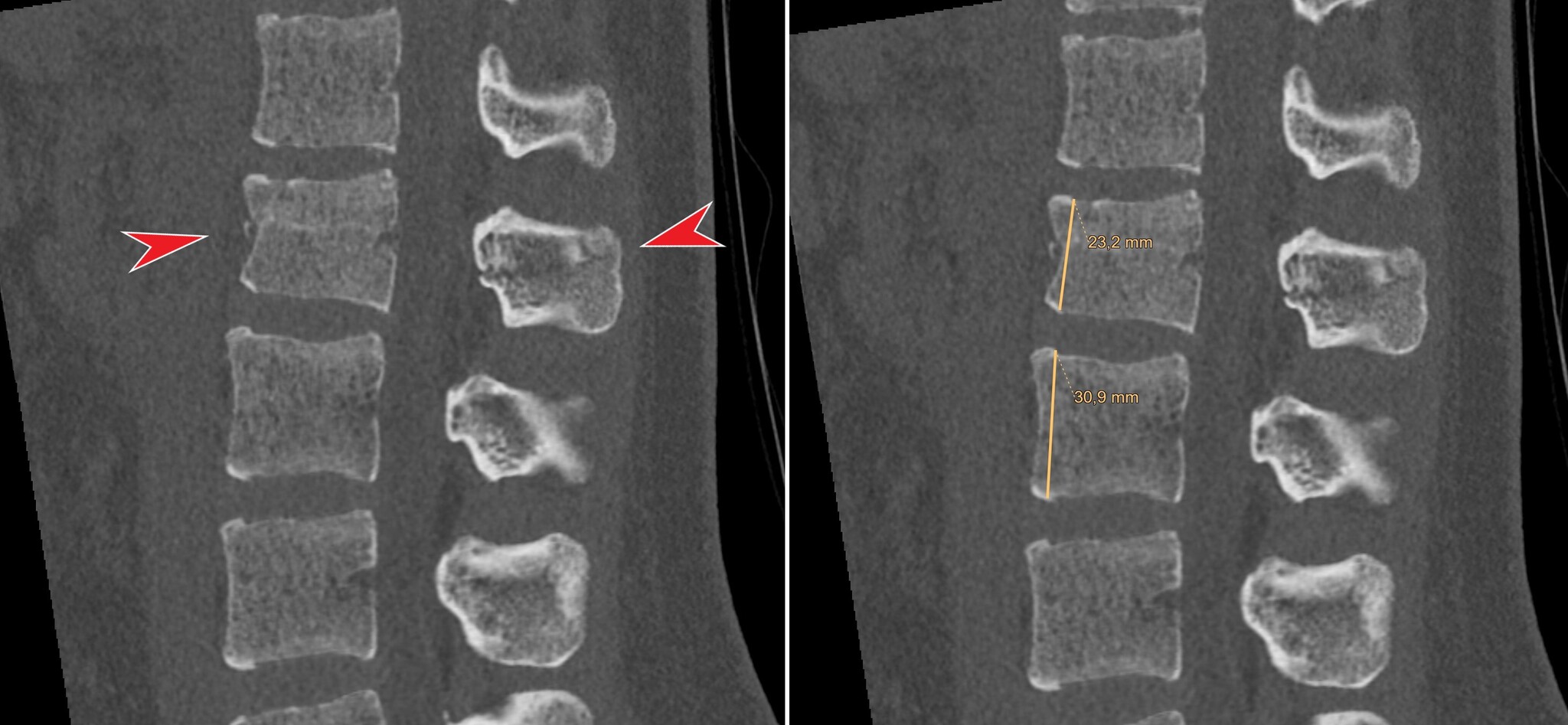 From practice: Chance fracture - My, Personal experience, Fracture of the spine, X-ray, CT, Radiology, Radiology, Disease history, Video, Soundless, Longpost