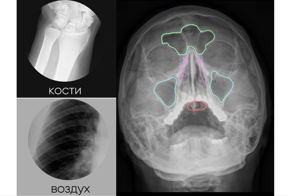 Снимок гайморовых пазух: КТ или рентген?​ – ЛенТомограф