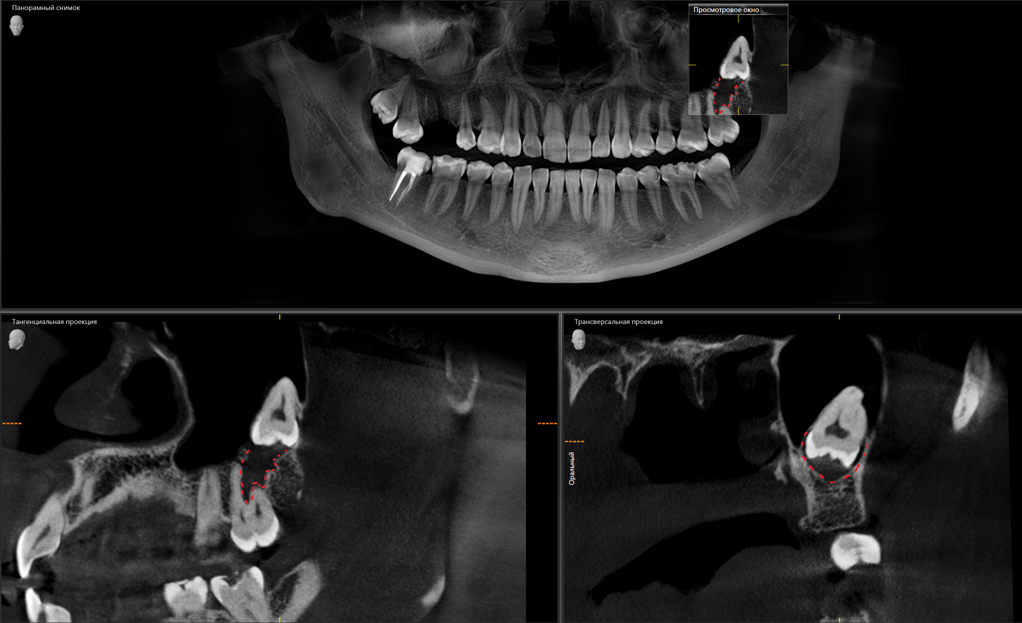 Панорамный снимок зубов мудрости