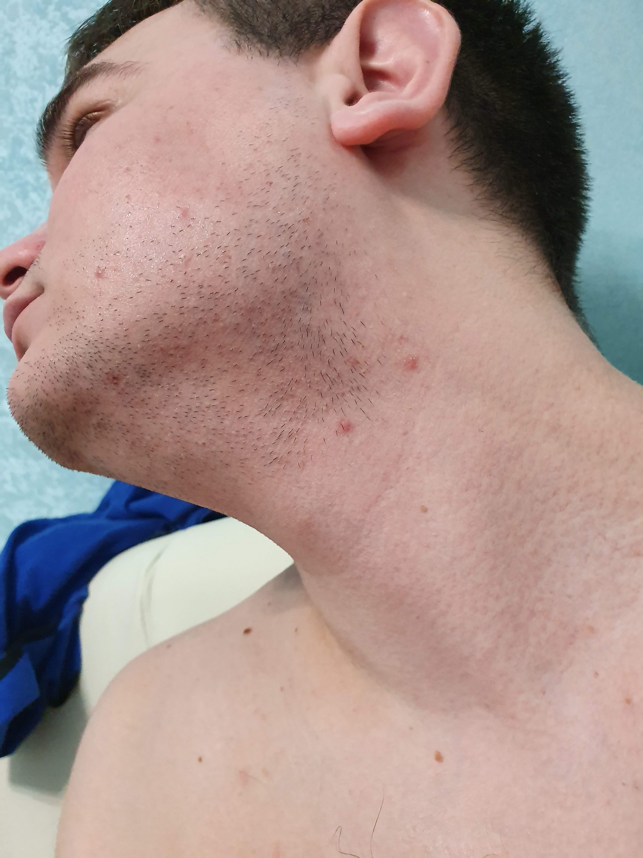 Borodostin Minoxidil. My result in 4 months - My, Beard, Minoxidil, Hair, First post, Longpost