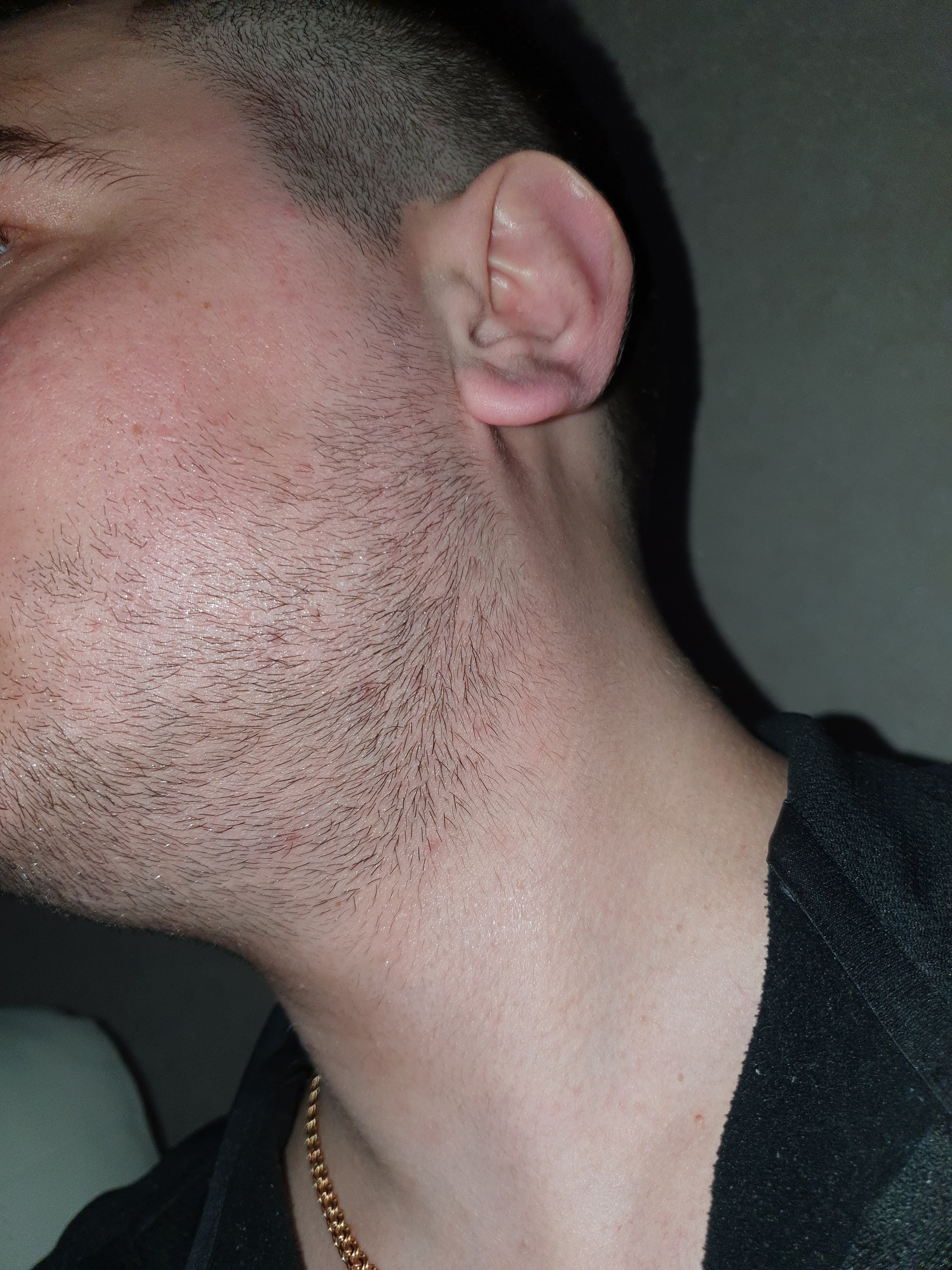 Borodostin Minoxidil. My result in 4 months - My, Beard, Minoxidil, Hair, First post, Longpost