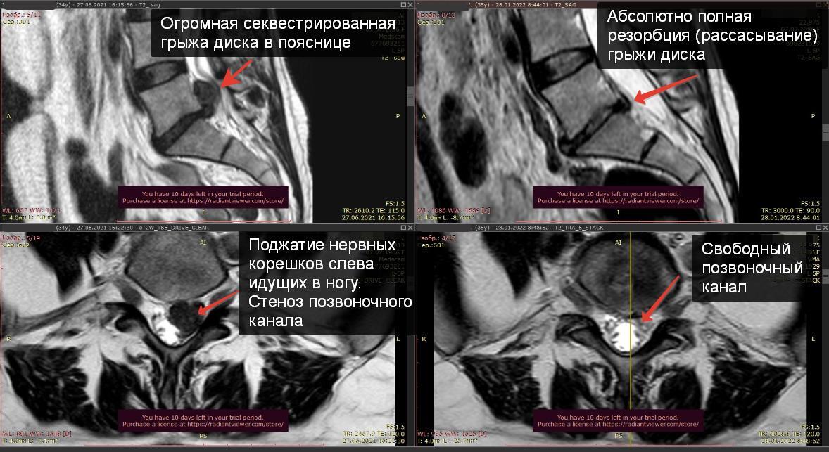 How is the effectiveness of non-surgical treatment of disc herniation evaluated? - My, The medicine, Treatment, Health, Operation, Intervertebral hernia, Doctors