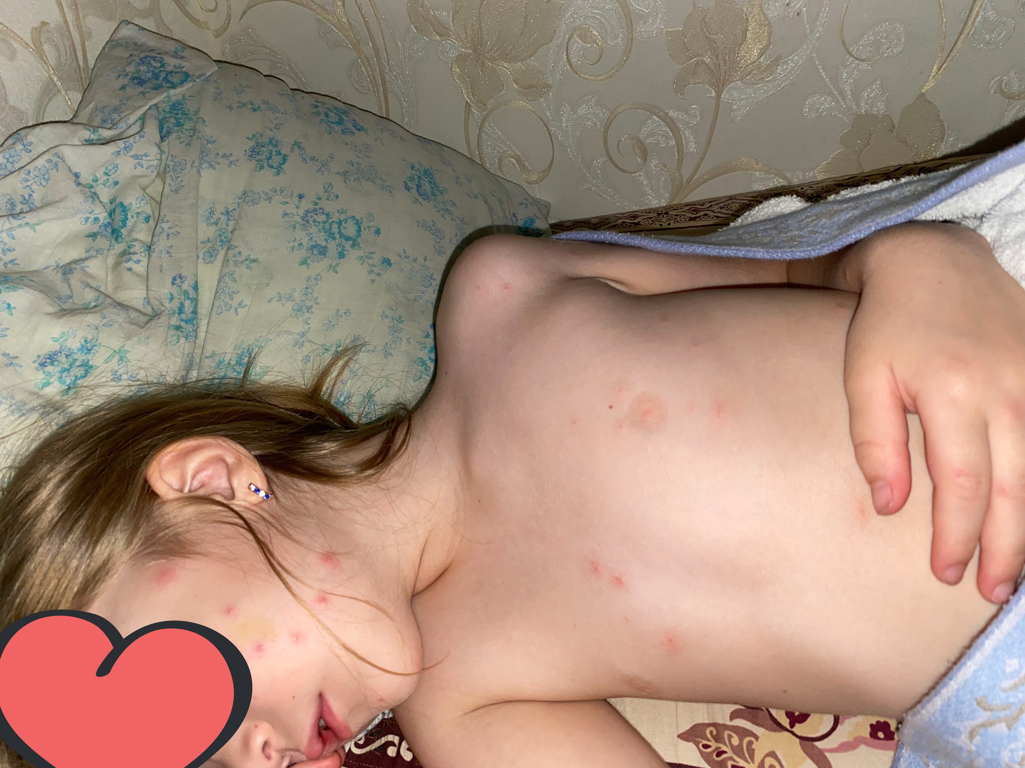 Secondary chickenpox or what kind of acne? - Acne, Chickenpox, Scabies, Itches, Itch, Longpost