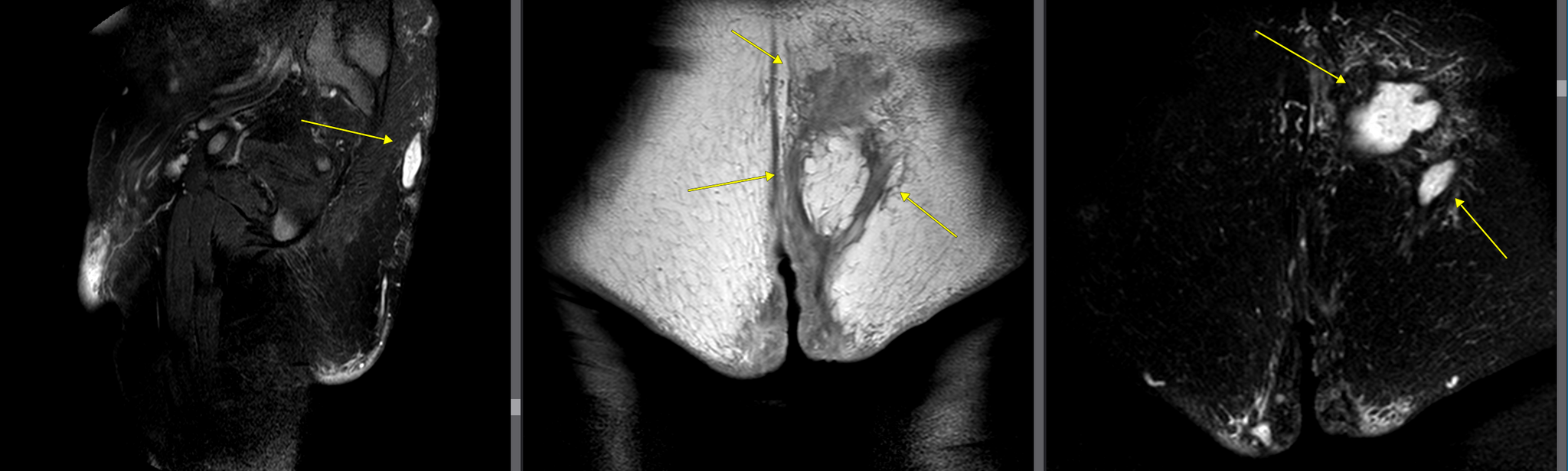 The wildest rectal fistula I've ever seen - My, Screenshot, Oddities, MRI, The medicine, Disease, Proctology, Fistula, Paraproctitis rectal fistula, Longpost