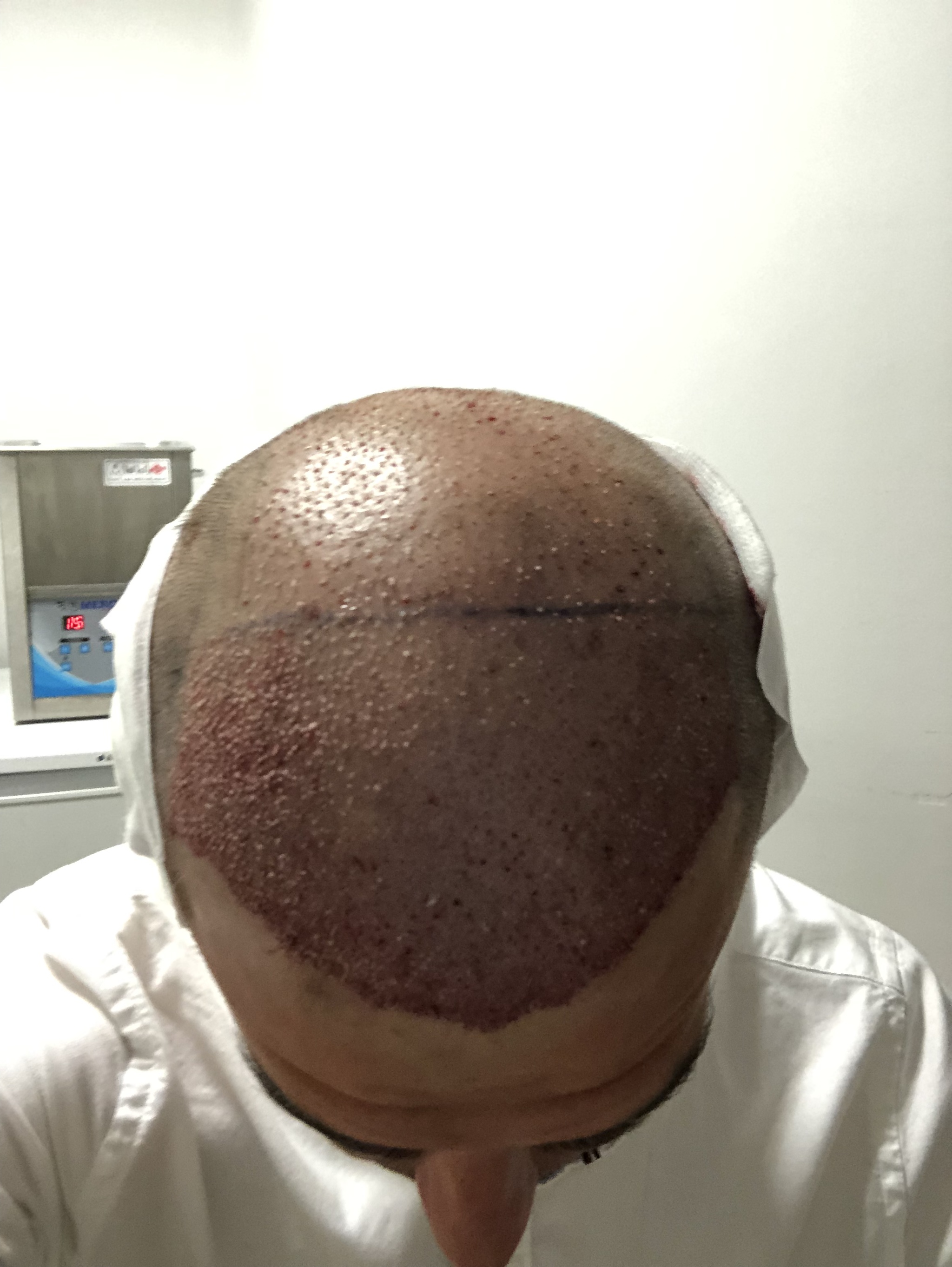 And yet I did it) - Hair Transplant, Finished, Joy, Longpost