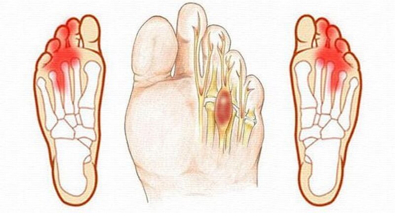 Clinic for Dummies 18 (Morton's Neuroma) - My, The medicine, Doctors, Health, Treatment, Longpost, Polyclinic, Operation