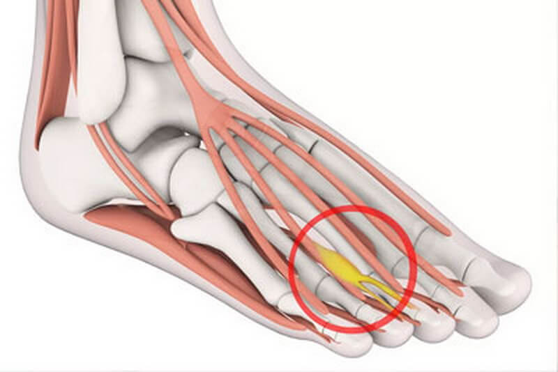 Clinic for Dummies 18 (Morton's Neuroma) - My, The medicine, Doctors, Health, Treatment, Longpost, Polyclinic, Operation