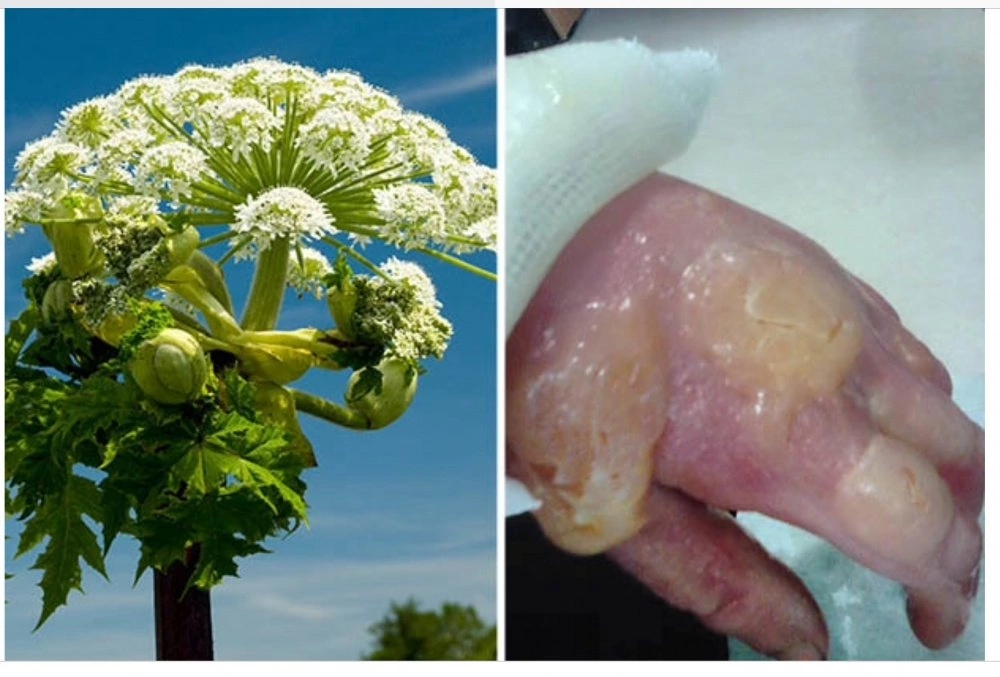 What is dangerous hogweed - My, Ambulance, The medicine, Pediatrics, Plants, Hogweed, Burn, Longpost