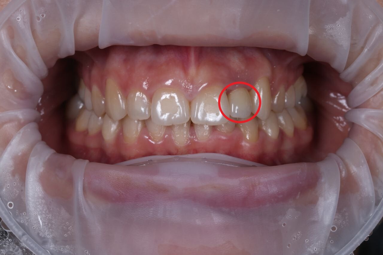 2.5 years of wearing braces - My, Braces, Result, It Was-It Was, Dentistry, Teeth, Implants, Longpost