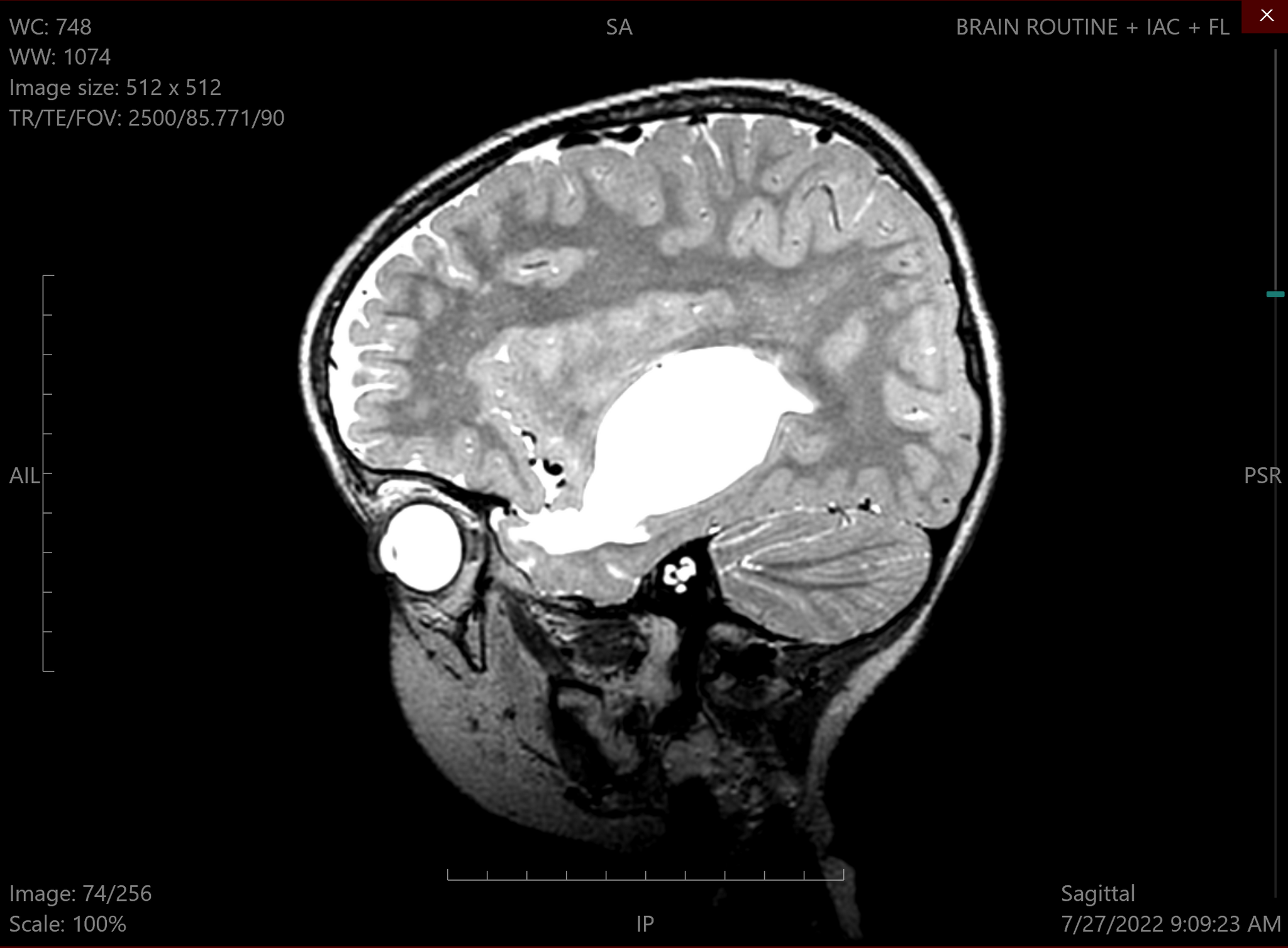 Киста в головном мозге у ребенка. Постишемические кисты мозга