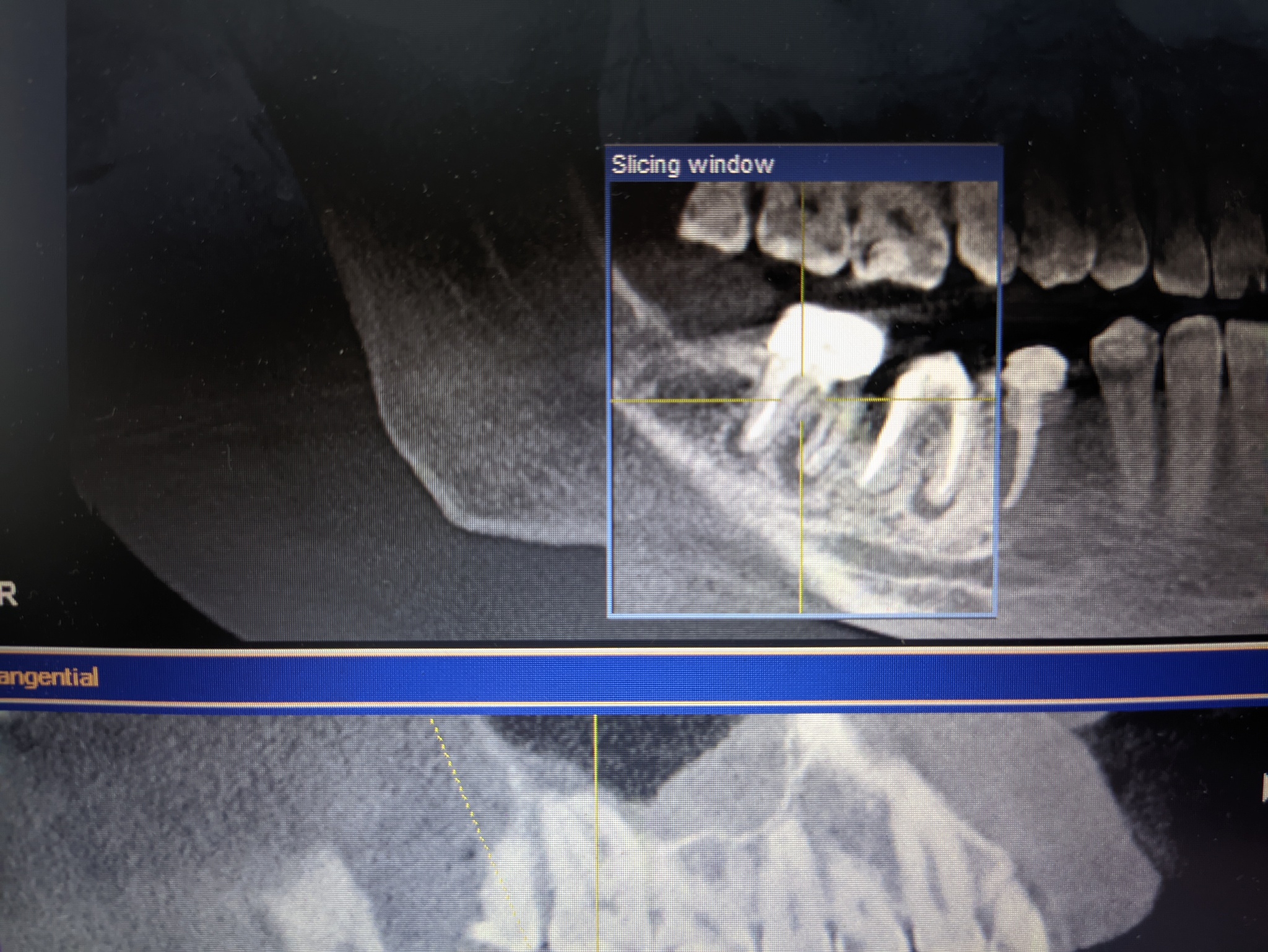 Tooth destruction due to improper treatment and implantation in another clinic - Dentistry, Dental implantation, Error, Orthopedics, CT, No rating