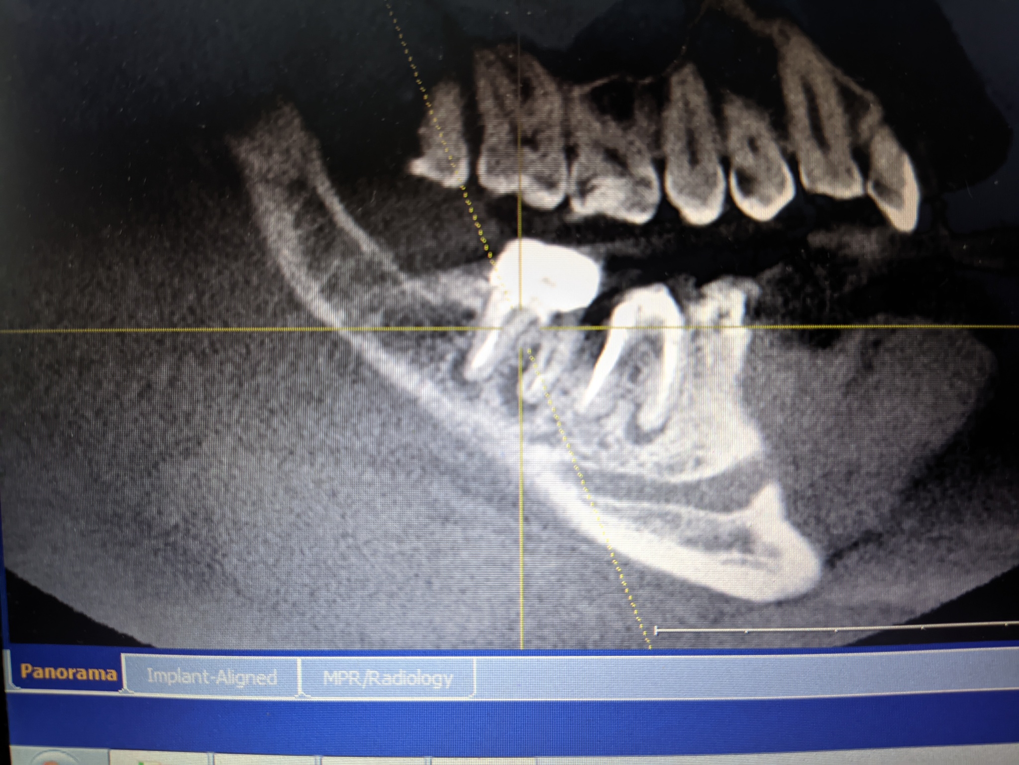 Tooth destruction due to improper treatment and implantation in another clinic - Dentistry, Dental implantation, Error, Orthopedics, CT, No rating