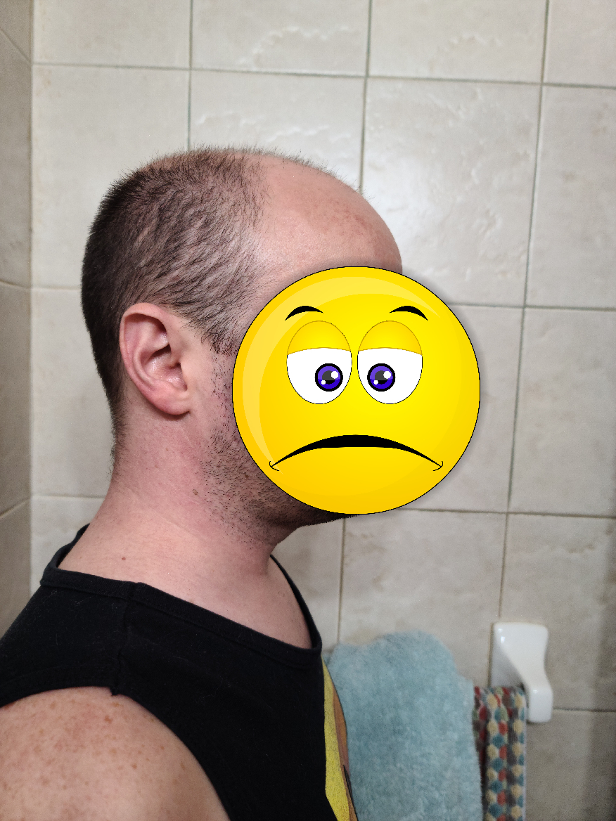 My experience with the hair system, or how to go from bald to hairy - My, Стрижка, Age, Longpost, Baldness, Wig, Personal experience