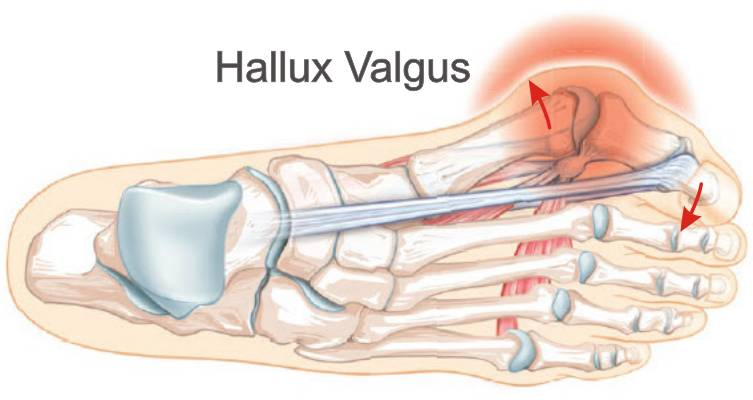 Hallux valgus или шишки на стопах - Моё, Здоровье, Медицина, Стопы, Длиннопост