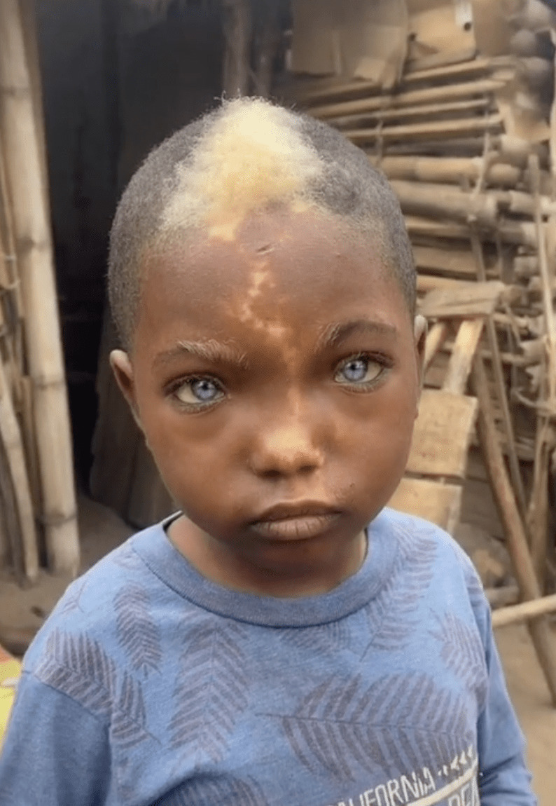 Wonders of nature - The photo, Children, Mutation, Black people, Blue eyes, Vitiligo