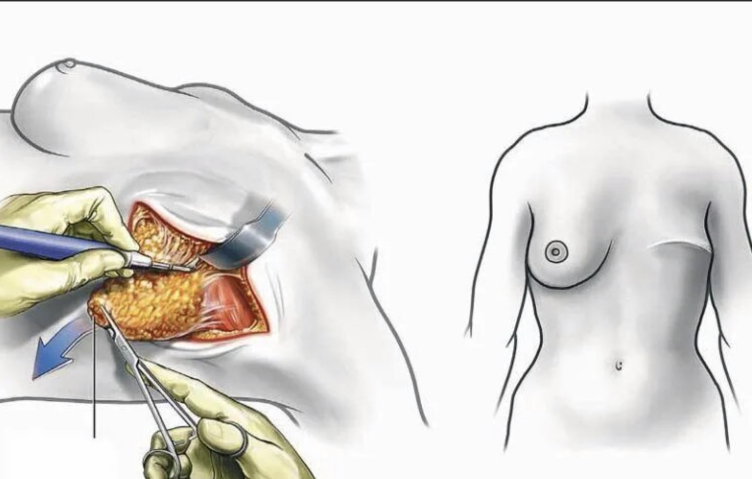 Breast reconstruction - My, Cancer and oncology, Surgeon, Plastic surgery, Doctors, Vertical video, Longpost