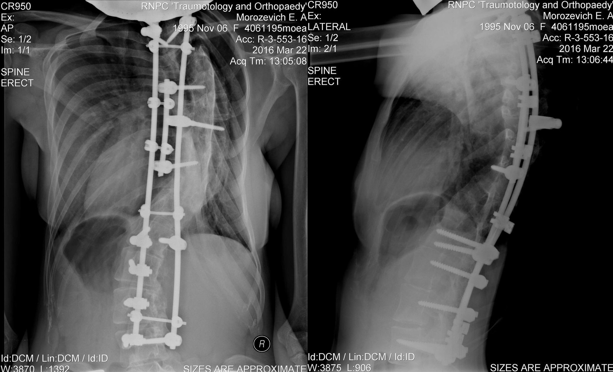 Idiopathic scoliosis and my life with it. Spine surgery - My, Scoliosis, Operation, Spine, Surgery, Longpost