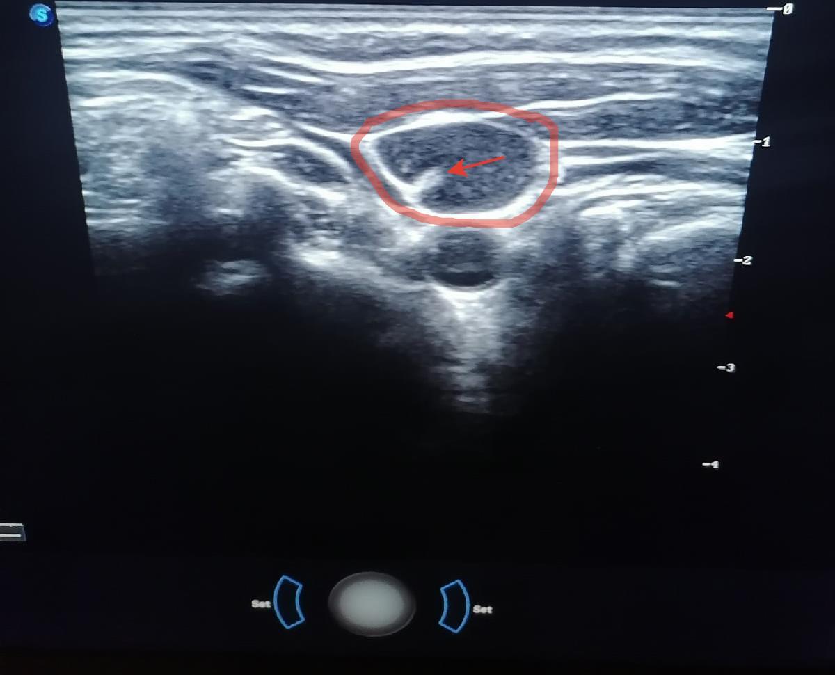 Что видит врач при проведении УЗИ - Моё, Медицина, Врачи, Больница, УЗИ, Диагностика, Длиннопост