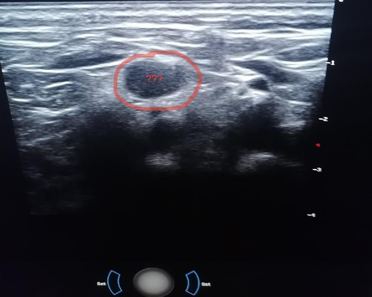Что видит врач при проведении УЗИ - Моё, Медицина, Врачи, Больница, УЗИ, Диагностика, Длиннопост