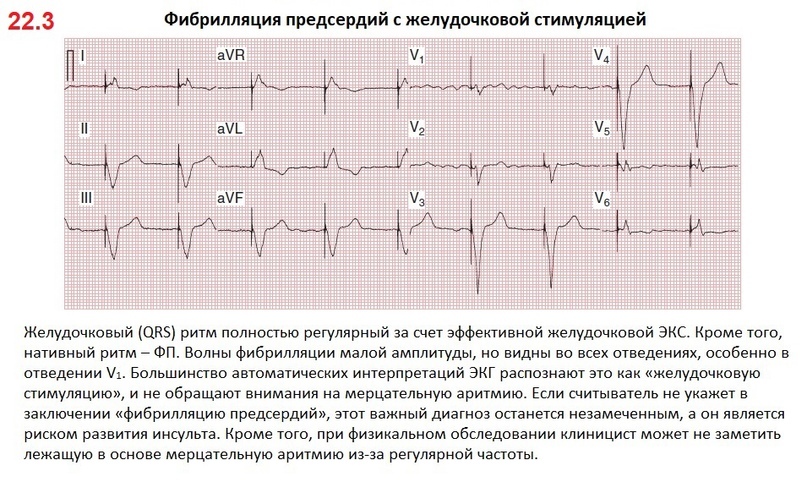 Pacemakers and Implantable Cardioverter-Defibrillators: Essentials for Clinicians. Part 1 - My, The medicine, Doctors, ECG, Medical student, Interesting, Health, Hospital, Disease, Disease history, Treatment, Longpost
