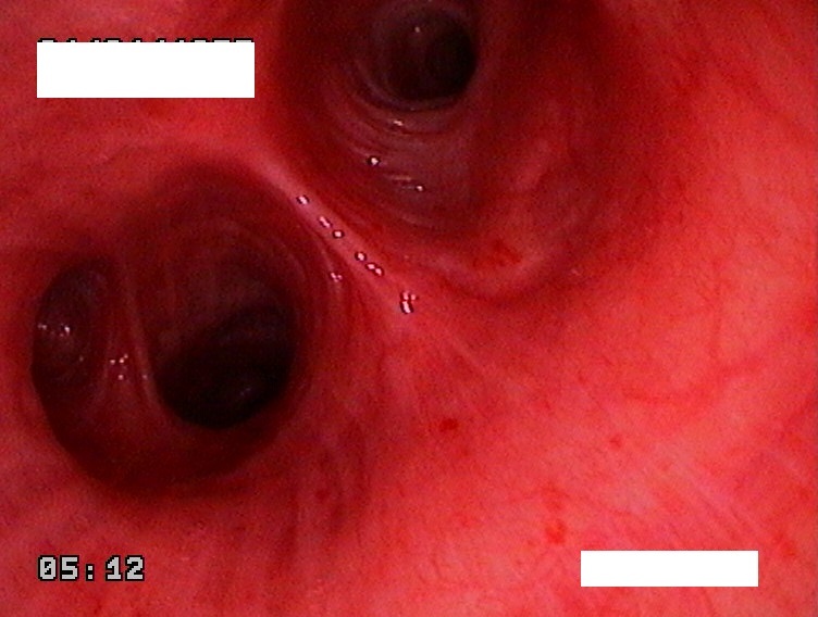 Endophotos. Part 4. Trachea and bronchi - My, The medicine, Endoscopy, Cancer and oncology, Bronchoscopy, Longpost